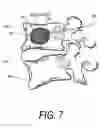 Fig. 07 - Composite implant and method for treating bone abnormalities
