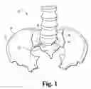 Fig. 02 - Methods and instrumentation for positioning implants in spinal disc space in an anterior lateral approach