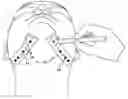 Fig. 01 - Surgical tape and method for using same