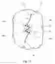 Fig. 08 - Visceral anchors for purse-string closure of perforations