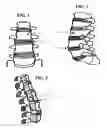 Fig. 02 - Apparatus for anterior intervertebral spinal fixation and fusion