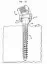Fig. 09 - Methods for stabilizing bone using spinal fixation devices