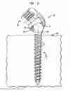 Fig. 10 - Methods for stabilizing bone using spinal fixation devices
