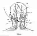 Fig. 04 - Method of implanting a medical lead