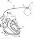 Fig. 01 - RF rejecting lead