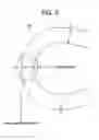 Fig. 04 - Balloon expandable bioabsorbable drug eluting stent