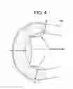 Fig. 05 - Balloon expandable bioabsorbable drug eluting stent