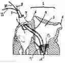 Fig. 01 - Inflatable artificial valve