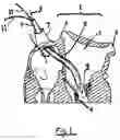 Fig. 02 - Inflatable artificial valve