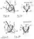 Fig. 06 - Inflatable artificial valve