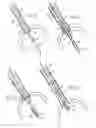 Fig. 04 - Prosthetic valve for transluminal delivery