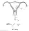 Fig. 13 - Methods, systems and devices for performing gynecological procedures