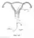 Fig. 17 - Methods, systems and devices for performing gynecological procedures