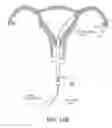 Fig. 18 - Methods, systems and devices for performing gynecological procedures