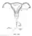 Fig. 20 - Methods, systems and devices for performing gynecological procedures