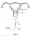 Fig. 22 - Methods, systems and devices for performing gynecological procedures