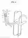 Fig. 05 - Balloon catheter, its fabrication method, and method for fixedly mounting a balloon on catheter tube