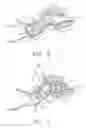 Fig. 04 - Semi-permanent canal hearing device and insertion method