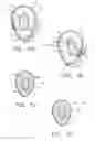 Fig. 06 - Semi-permanent canal hearing device and insertion method