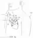 Fig. 02 - Heart assist devices, systems and methods