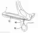 Fig. 01 - Inflatable prosthesis for aiding penile erection and augmentation