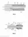 Fig. 04 - Coated Cannula with Protective Tip for Insertion Into a Patient