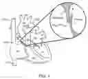 Fig. 02 - MULTI-ELECTRODE APPARATUS FOR TISSUE WELDING AND ABLATION