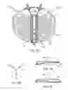 Fig. 06 - MULTI-ELECTRODE APPARATUS FOR TISSUE WELDING AND ABLATION