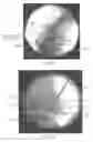 Fig. 09 - KIT AND METHODS FOR MEDICAL PROCEDURES WITHIN A SACRUM