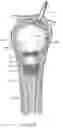 Fig. 09 - Systems and methods treating a vertebral body