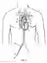 Fig. 02 - IMPLANT, SYSTEMS AND METHODS FOR PHYSICALLY DIVERTING MATERIAL IN BLOOD FLOW AWAY FROM THE HEAD