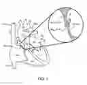 Fig. 02 - METHOD FOR SEALING A PFO USING AN ENERGY DELIVERY DEVICE