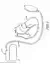 Fig. 02 - Apparatus for detecting and treating ventricular arrhythmia