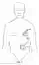 Fig. 08 - Apparatus for detecting and treating ventricular arrhythmia