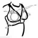 Fig. 01 - Excessive fibrous capsule formation and capsular contracture apparatus and method for using same