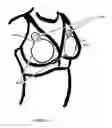 Fig. 06 - Excessive fibrous capsule formation and capsular contracture apparatus and method for using same