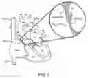 Fig. 02 - ELECTRODE APPARATUS HAVING DEFORMABLE DISTAL HOUSING