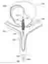 Fig. 01 - Over-the-wire exclusion device and system for delivery