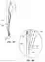 Fig. 04 - Bypass vascular graft