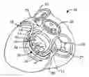 Fig. 01 - Fixed anchor and pull mitral valve device and method