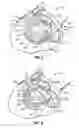 Fig. 03 - Fixed anchor and pull mitral valve device and method