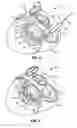 Fig. 04 - Fixed anchor and pull mitral valve device and method