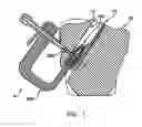 Fig. 02 - Apparatus and method for attaching a graft ligament to a bone
