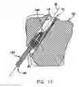 Fig. 07 - Apparatus and method for attaching a graft ligament to a bone