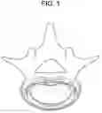 Fig. 02 - Nucleus replacement device and method
