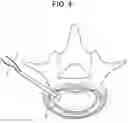 Fig. 05 - Nucleus replacement device and method