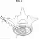 Fig. 06 - Nucleus replacement device and method