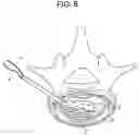 Fig. 07 - Nucleus replacement device and method