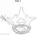 Fig. 08 - Nucleus replacement device and method