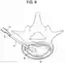 Fig. 10 - Nucleus replacement device and method